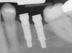 X-ray of an implant in position